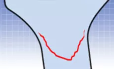 Grieta con forma de sonrisa